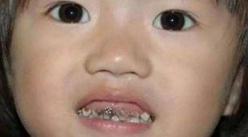 吃瓜把牙齿咬坏了,牙齿“咬”出健康危机